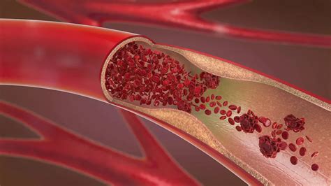 cum să consolideze vasele de sânge dacă există vene varicoase